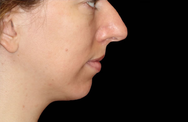 Facial profile before procedure