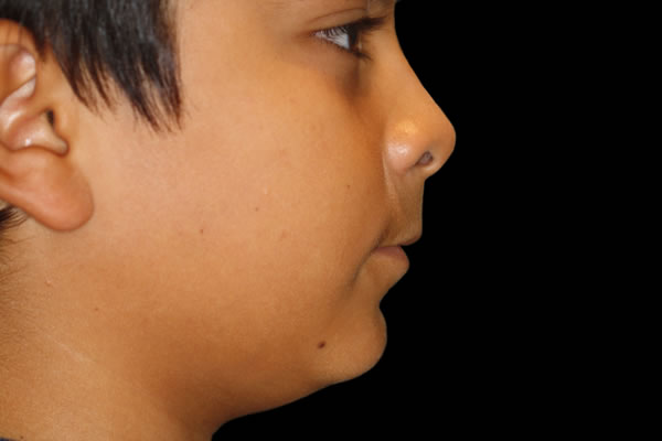 Facial profile before procedure