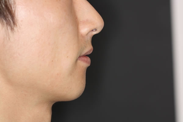 Facial profile after procedure